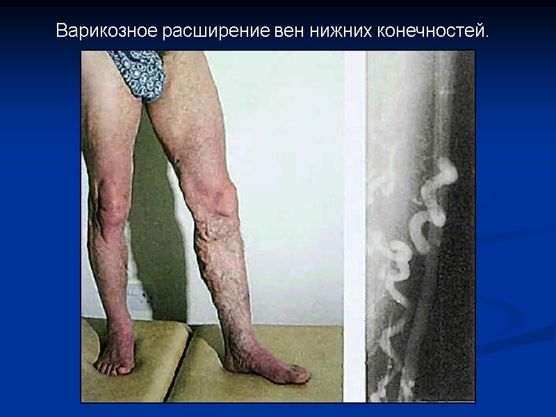 Варикозное расширение вен нижних конечностей.